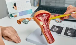 Model macicy z zaznaczonym polipem endometrialnym. Lekarz wyjaśnia pacjentce budowę narządu.
