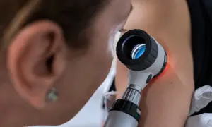 Lekarz bada znamiona dermatoskopem. Kto może wystawić skierowanie do dermatologa? Zwykle lekarz rodzinny, gdy zauważy niepokojące zmiany skórne.