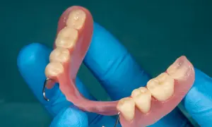 Proteza na NFZ Warszawa. Dentyści w niebieskich rękawiczkach prezentują protezę zębową z metalowymi zaczepami.