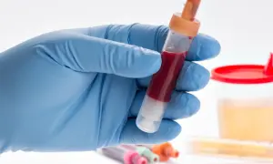 Rękawiczka w niebieskiej rękawiczce trzyma probówkę z ciemnoczerwonym płynem, sugerującym jak wygląda krwiomocz zdjęcia.