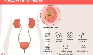 Ilustracja przedstawia układ moczowy i przyczyny kamieni nerkowych: niedobór płynów, witamin, nadwagę, predyspozycje genetyczne, siedzący tryb życia, choroby układu pokarmowego i nieodpowiednią dietę.
