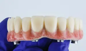 Proteza zębowa na implantach, wykonana w ramach NFZ. Sztuczne zęby z różową podstawą, trzymane w niebieskiej rękawiczce.