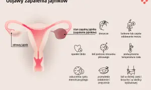 Ilustracja przedstawia objawy zapalenia przydatków: ból, gorączkę, problemy z oddawaniem moczu, spadek libido, ból podczas stosunku, zaburzenia cyklu, zmęczenie i ból brzucha.
