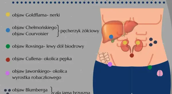 Ilustracja pokazuje lokalizację objawów wskazujących na zapalenie otrzewnej, takich jak objaw Cullena w okolicy pępka czy objaw Blumberga w całej jamie brzusznej.
