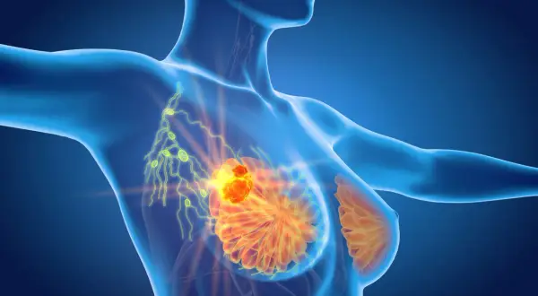 Model anatomiczny ukazujący skupisko komórek rakowych w piersi i węzły chłonne pod pachą, które mogą powodować ból pod pachą.