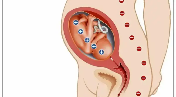 Płód z antygenami Rh+ w macicy matki Rh-. Ilustracja pokazuje potencjalny konflikt serologiczny.