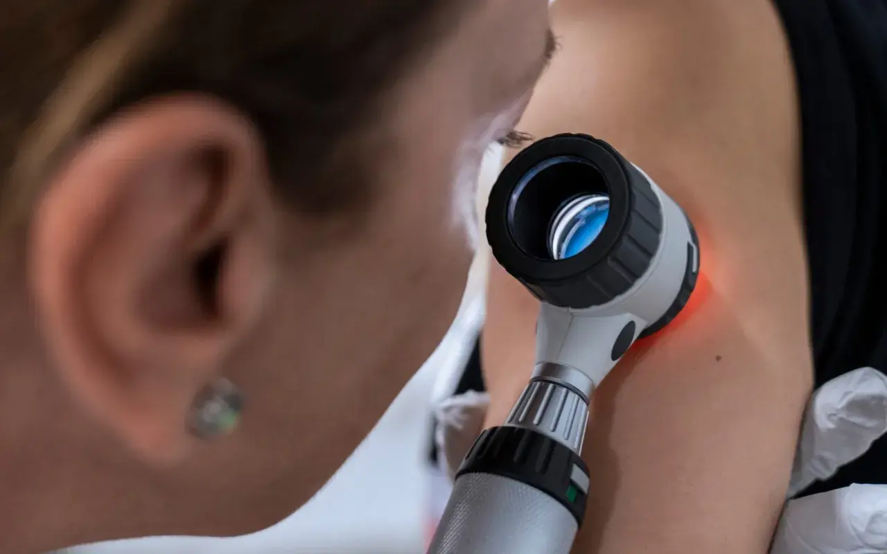 Lekarz bada znamiona dermatoskopem. Kto może wystawić skierowanie do dermatologa? Zwykle lekarz rodzinny, gdy zauważy niepokojące zmiany skórne.