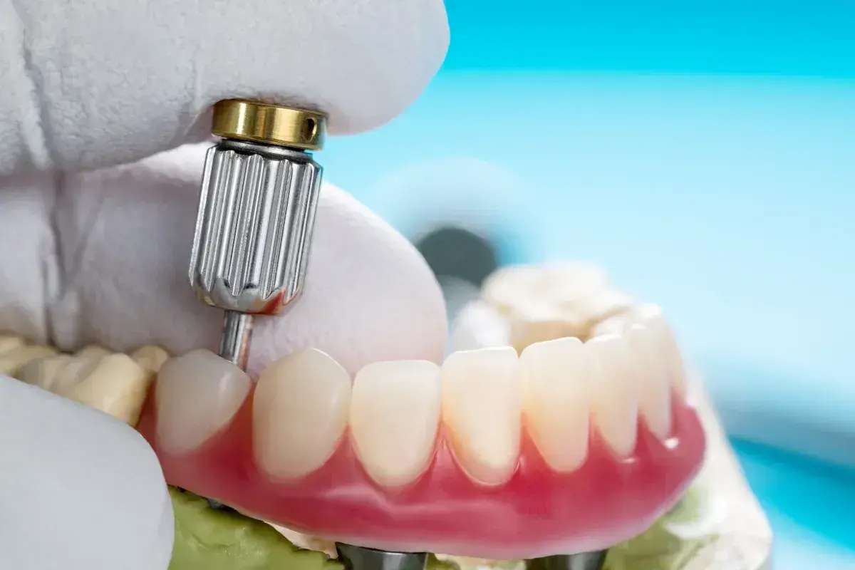 Dentyści pracują nad sztucznymi zębami na NFZ. Zbliżenie na protezę i narzędzie.