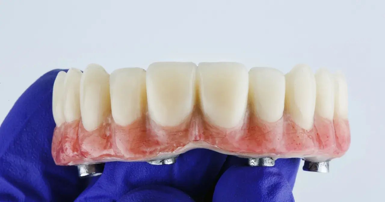 Proteza zębowa na implantach, wykonana w ramach NFZ. Sztuczne zęby z różową podstawą, trzymane w niebieskiej rękawiczce.
