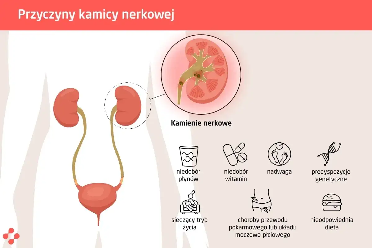 Ilustracja przedstawia układ moczowy i przyczyny kamieni nerkowych: niedobór płynów, witamin, nadwagę, predyspozycje genetyczne, siedzący tryb życia, choroby układu pokarmowego i nieodpowiednią dietę.
