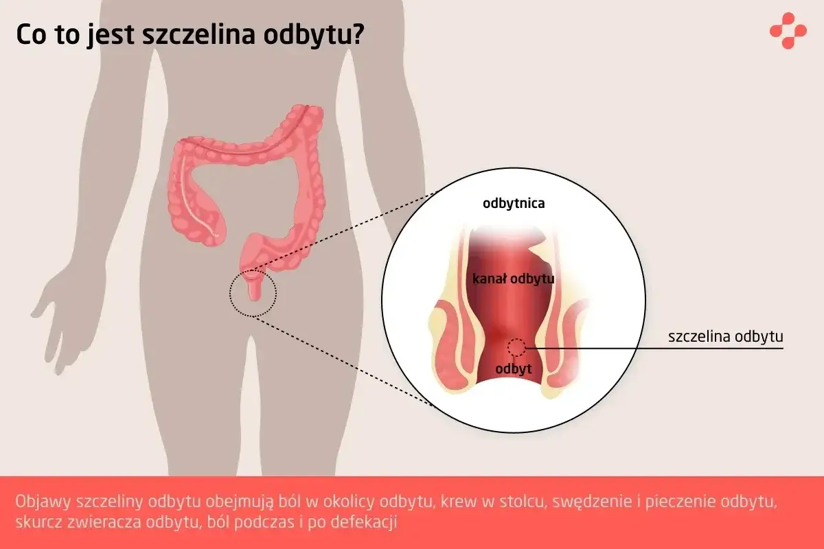 Ilustracja anatomiczna przedstawia jelito grube i odbytnicę, z powiększeniem ukazującym szczelinę odbytu, która może powodować dyschezję.