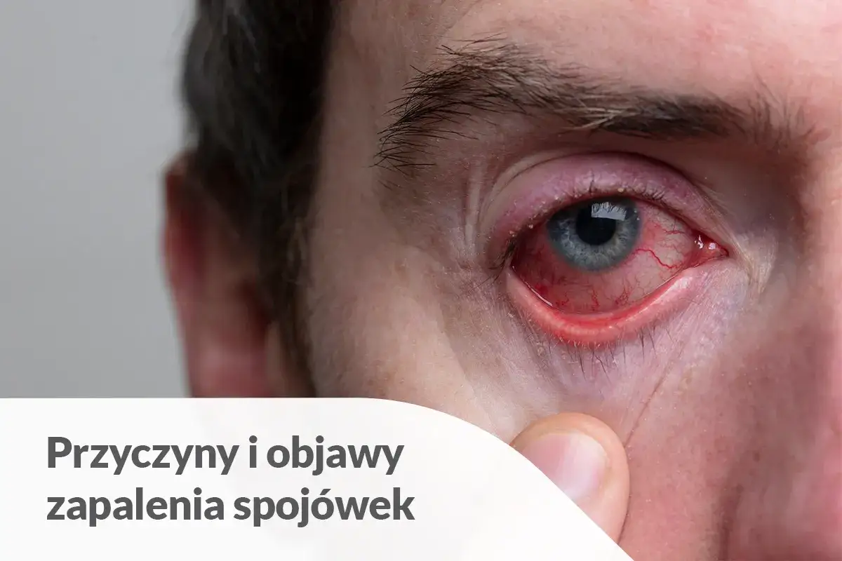 Silnie zaczerwienione oko, objaw zapalenia spojówek, z widocznymi naczynkami. Tekst informuje o przyczynach i objawach.
