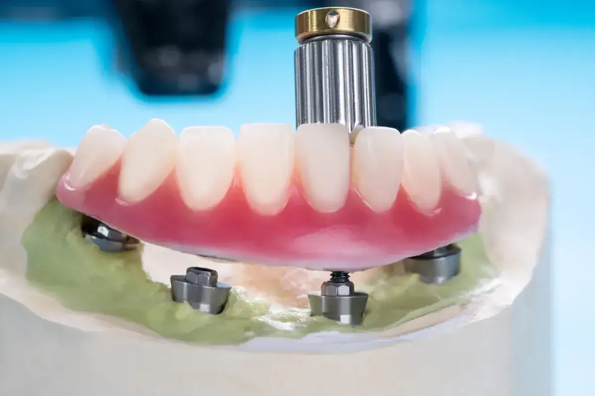 Model szczęki z protezą zębową na implantach. Sprawdź, czy przysługuje Ci nfz dofinansowanie do protez zębowych.