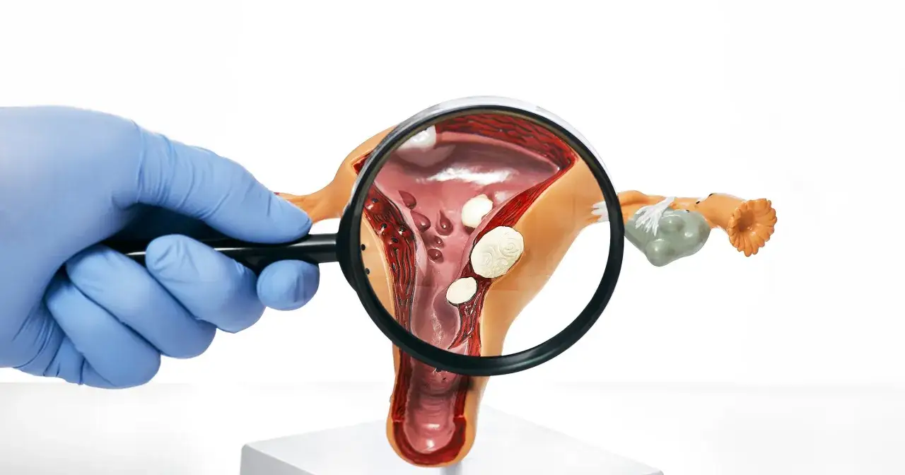 Model macicy z widocznymi zmianami, powiększony lupą. Widać polip endometrialny.