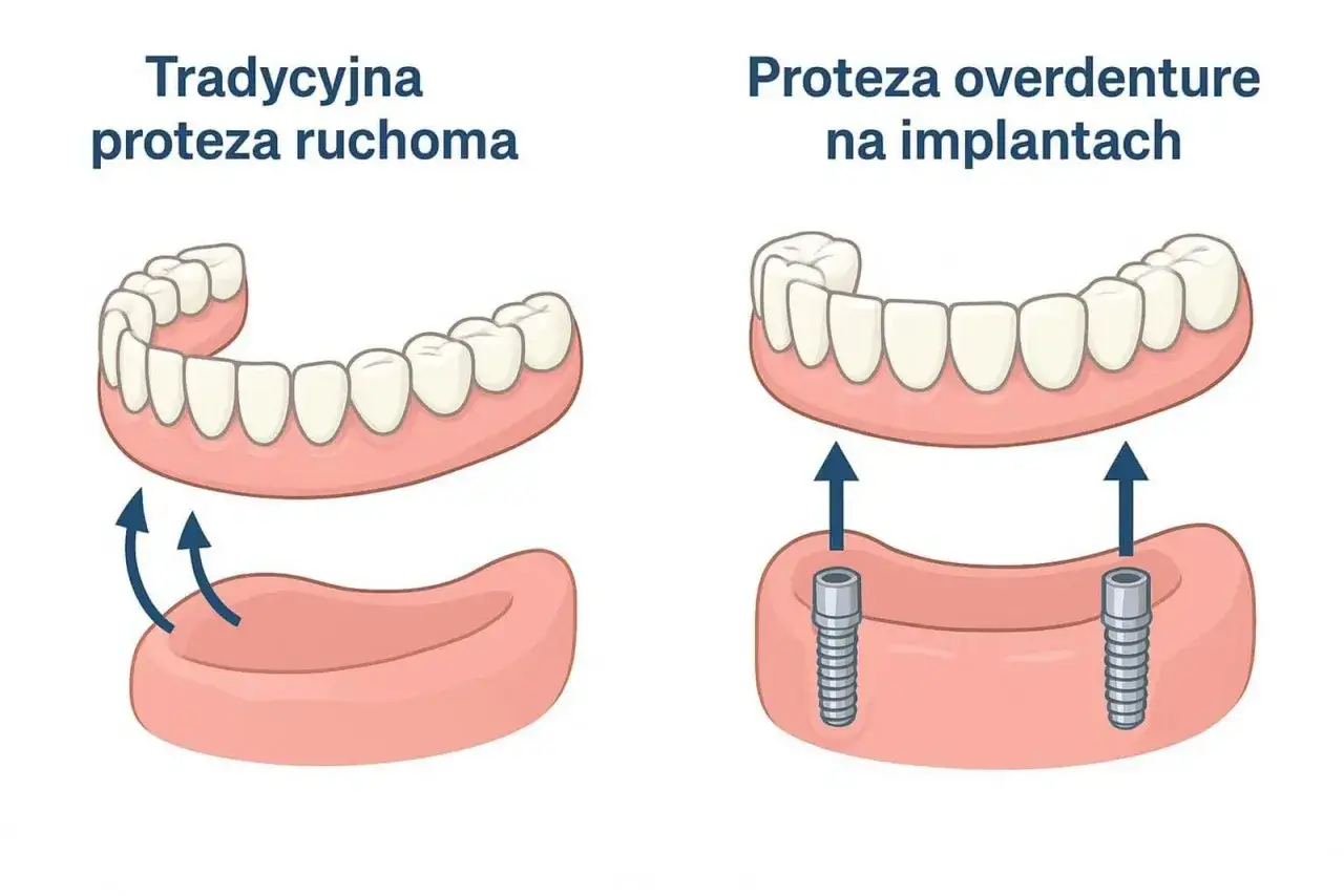 Porównanie tradycyjnej protezy ruchomej z protezą overdenture na implantach. Proteza na implantach NFZ to stabilne rozwiązanie.