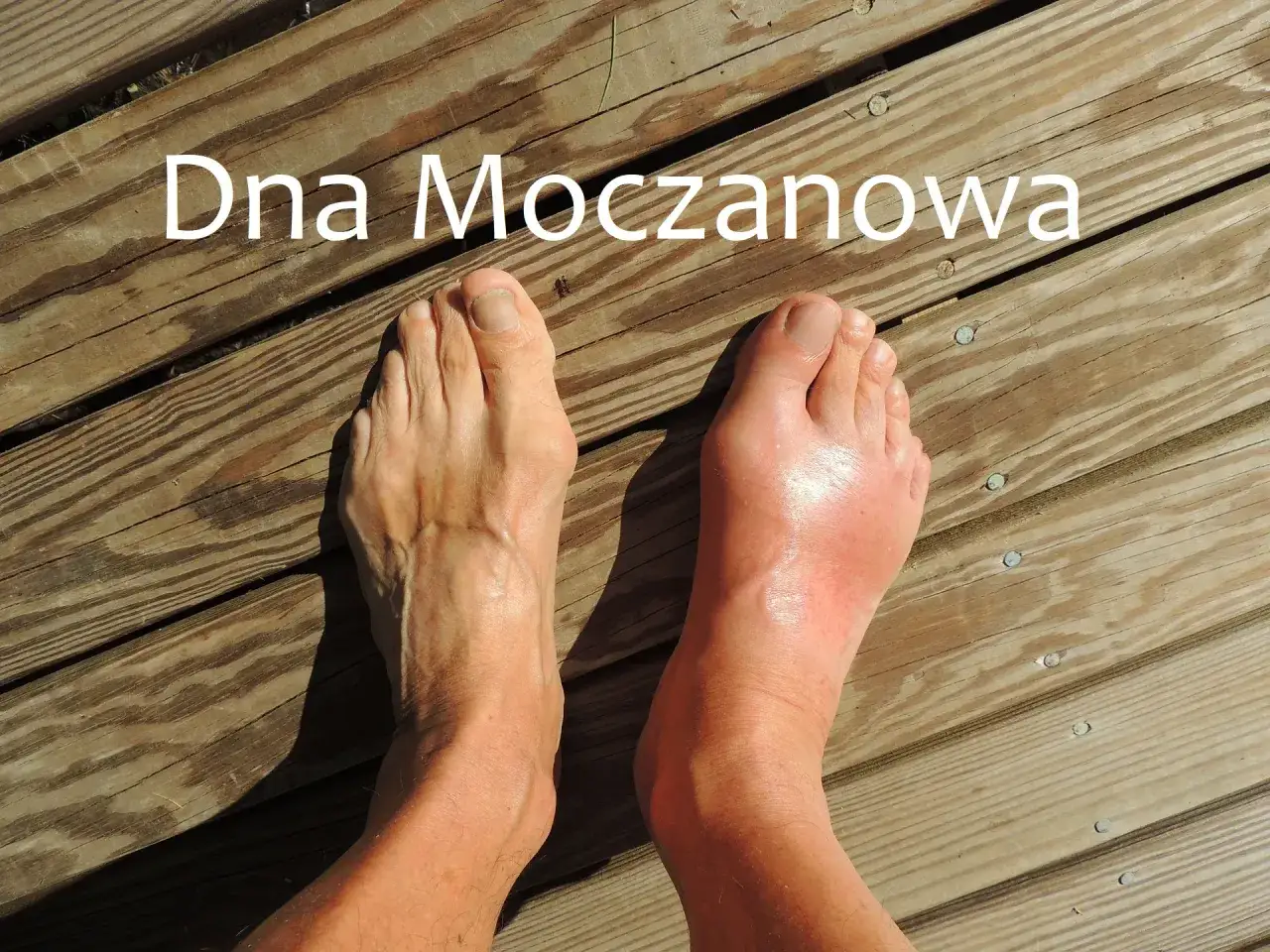 Dna moczanowa utrudnia chodzenie. Prawa stopa jest opuchnięta i zaczerwieniona, lewa wygląda zdrowo.