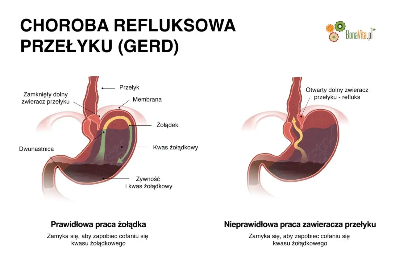Ilustracja pokazuje prawidłowe i nieprawidłowe działanie zwieracza przełyku, wyjaśniając najgorsze objawy refluksu.