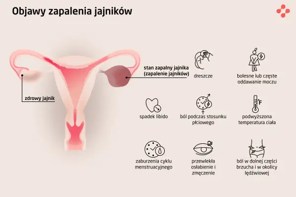 Ilustracja przedstawia objawy zapalenia przydatków: ból, gorączkę, problemy z oddawaniem moczu, spadek libido, ból podczas stosunku, zaburzenia cyklu, zmęczenie i ból brzucha.